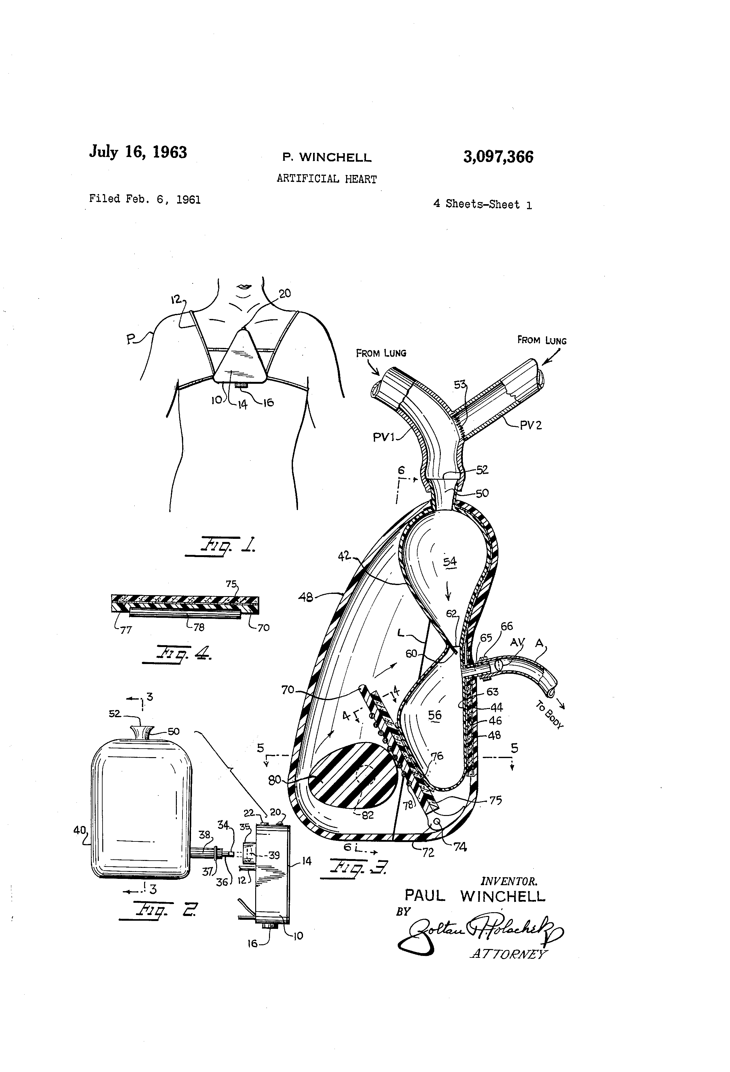 Today’s Patent- Artificial Heart